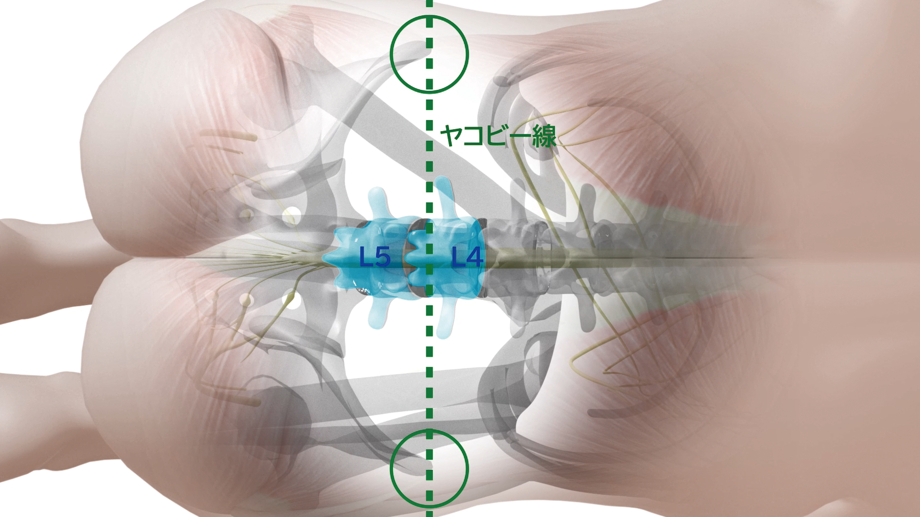 3DCG 腰椎穿刺